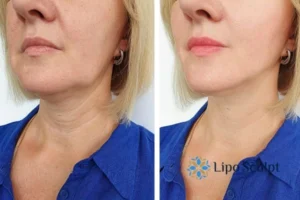 Double chin before and after Hi-Fu treatment 4 Book your double chin treatment Devizes today! We are here to help!
