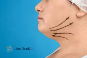 Double chin before and after Hi-Fu treatment 3 Boost your confidence with a Double chin treatment Devizes