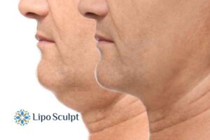 Double chin before and after Hi-Fu treatment 2 Double chin treatment Devizes from Lipo Sculpt - feel more confident today!