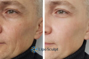 How to Fight Aging Symptoms 3 Fight Aging Symptoms Devizes With HIFU and Morpheus8 Today!