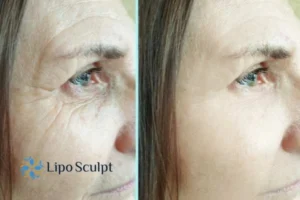 How to Fight Aging Symptoms 2 Do you want to Fight Aging Symptoms Devizes? Contact Lipo Sculpt today!