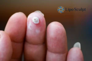 Cryopen Top 5 Treatable Conditions 4 Do you have a persistent wart of verruca that you cannot shit? Cryopen Devizes treatment will work call us NOW!