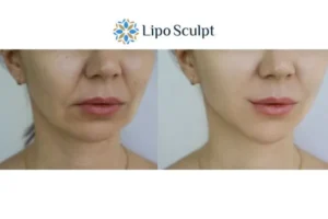 Explaining Total Skin Tightening Treatment And What It Can Do For You 2 Do you want to boost your self confidence? Give Morpheus8 Devizes a try today!