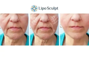 Explaining Total Skin Tightening Treatment And What It Can Do For You 3 Boost your confidence with Morpheus8 Devizes call our team today!