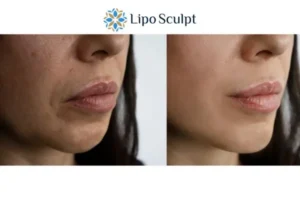Explaining Total Skin Tightening Treatment And What It Can Do For You 4 Morpheus8 Devizes the best results - call our team today!