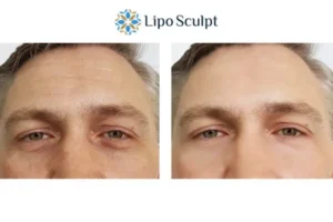 Explaining Total Skin Tightening Treatment And What It Can Do For You 6 Morpheus8 Devizes book in today to find out more!