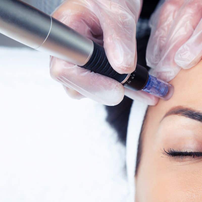 Morpheus8 treatment Devizes from Lipo Sculpt - Book in today!
