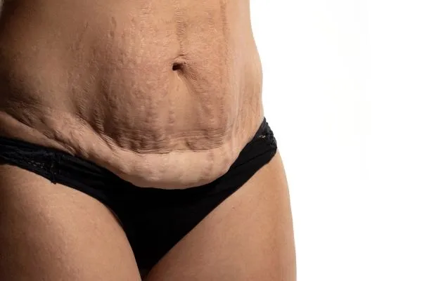 Lost the Weight but Not the Loose Skin? 1 image of womans stomach after weight loss showing loose skin Devizes
